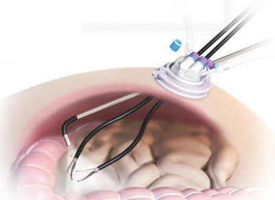 Advanced Laparoscopic Surgery