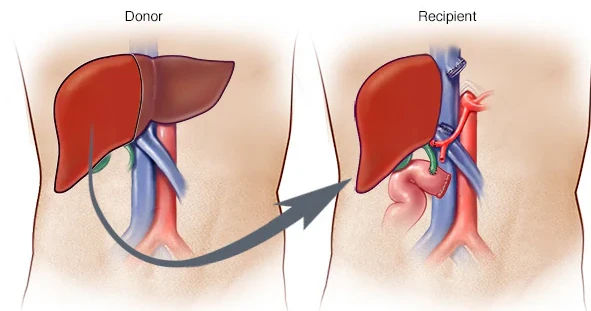 Liver Transplantation